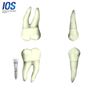 Micro-implant or mini-implant IOS